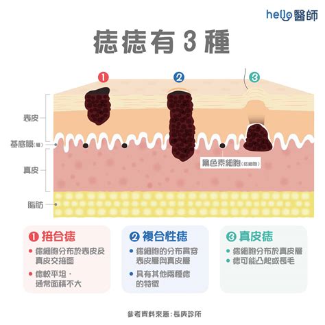 身體長痣的原因|痣形成的原因？痣長毛、痣變多變大是痣病變？5招判。